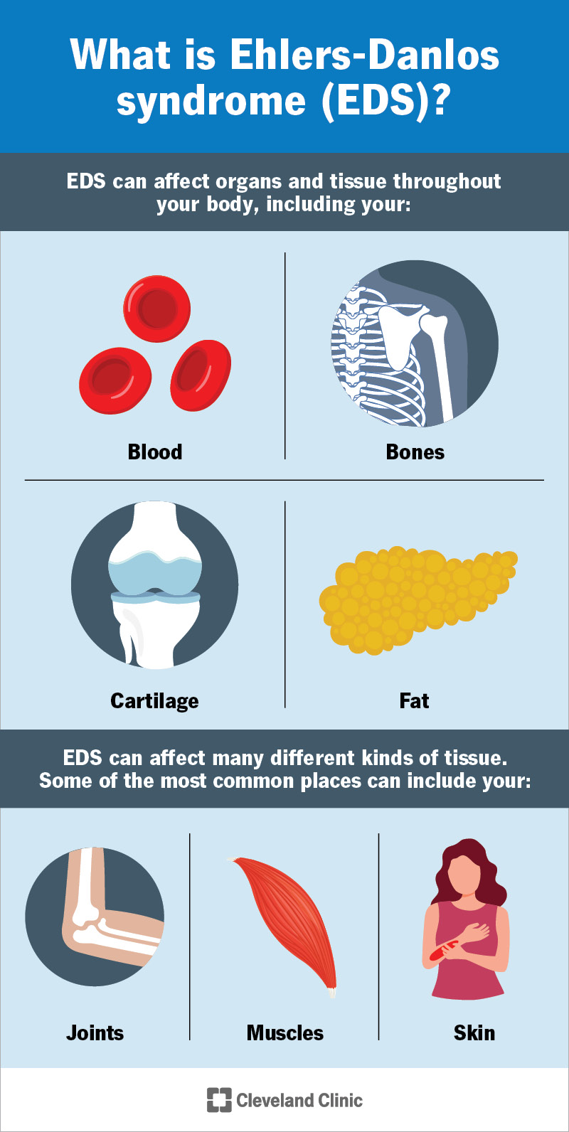 Recognizing EDS: Symptoms of Hypermobile, Classical, and Vascular Types